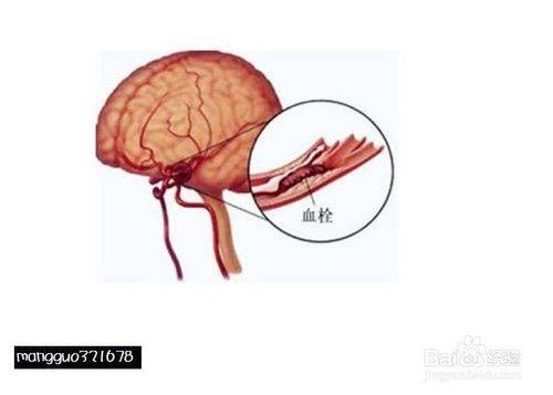轻度脑血栓