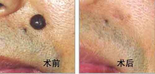 激光点痣