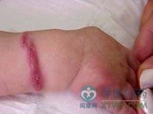 坏疽性脓皮症