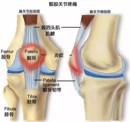 髌骨疼痛