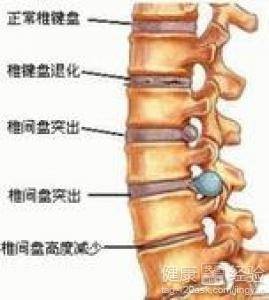 腰椎间盘突出症康复