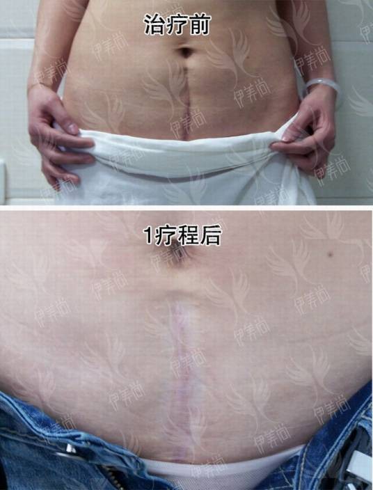 疤痕手术