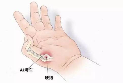 大拇指腱鞘炎