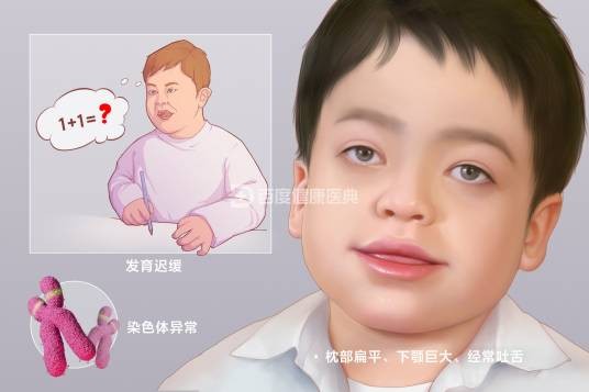 天使综合征