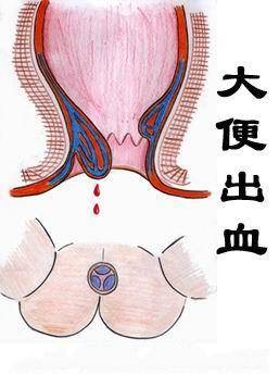 无痛性便血