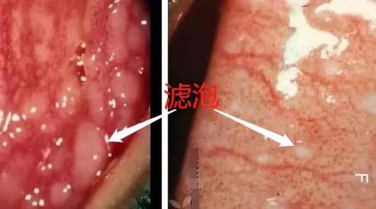 滤泡