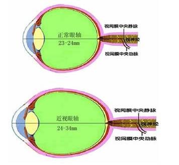 近视眼手术后遗症