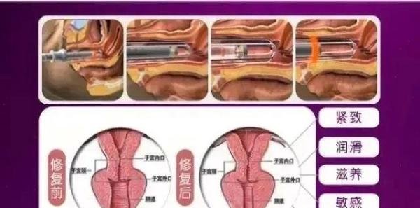 私密保养之“菲蜜丽”