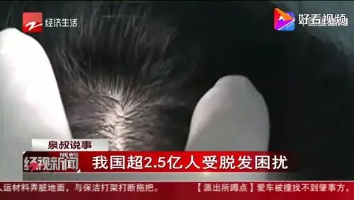 广州00后小伙为解压长期拔头发成了秃头,这件事给予我们哪些警示?