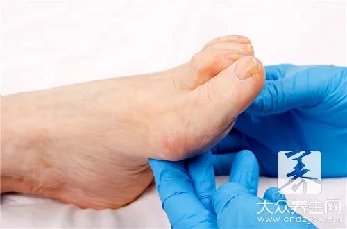 脚背不同位置的痣图解