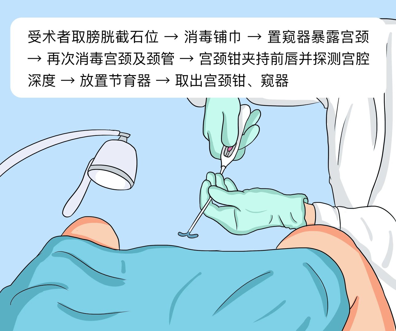 如何上环