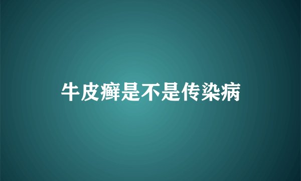 牛皮癣是不是传染病