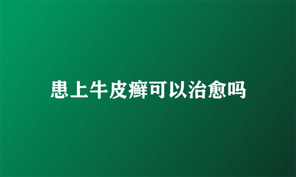 患上牛皮癣可以治愈吗