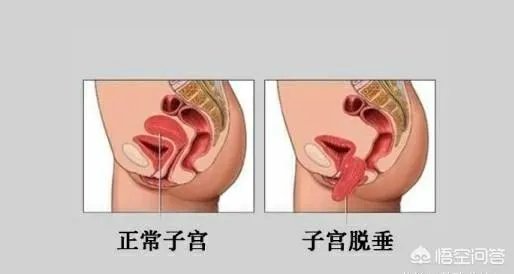 最近,我们最爱的Ella曝出产后膀胱脱垂、尿失禁,宝妈有什么方法可以进行恢复?