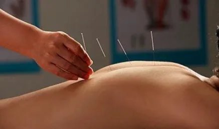 针灸减肥好吗?为什么?