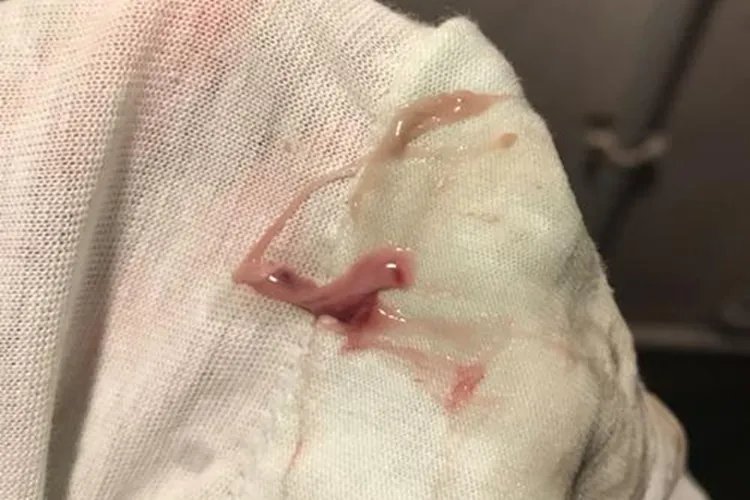 宫颈癌白带内裤照片