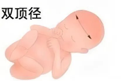 双顶径在哪个位置图片