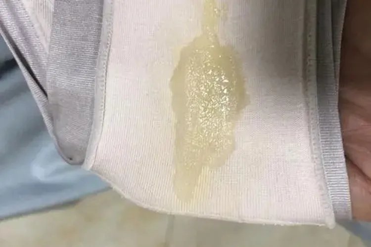 宫颈癌白带内裤照片