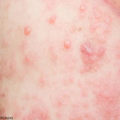 水痘止痒妙招有哪些 长水痘的注意事项