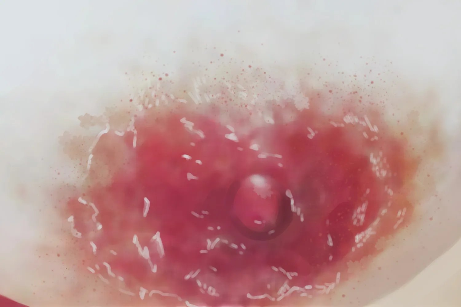 乳房湿疹样癌乳晕症状图片