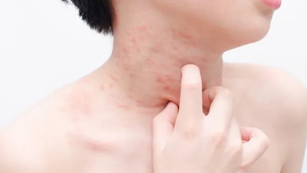 银屑病治疗方法