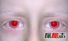 世界上最稀有的眼睛;紫色眼睛(概率只有千万分之一)