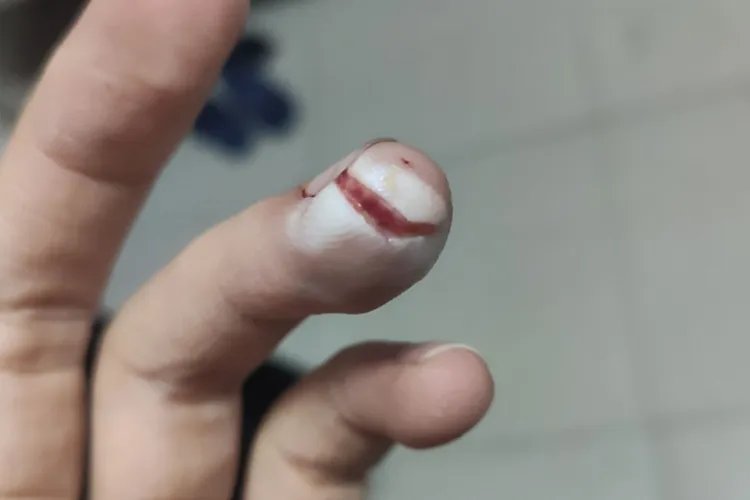手伤图片