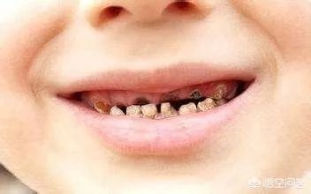 被虫蛀的牙只能拔掉吗