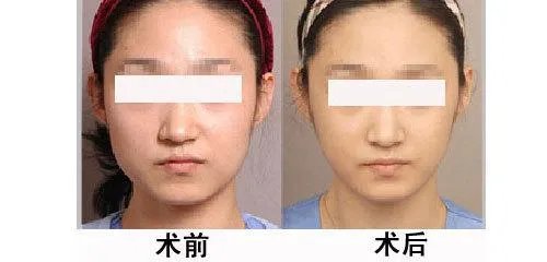 打瘦脸针的副作用