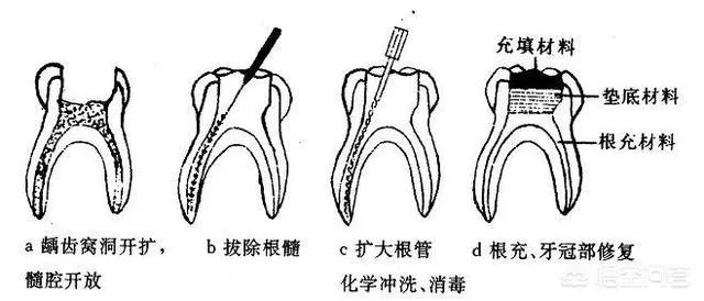 被虫蛀的牙只能拔掉吗