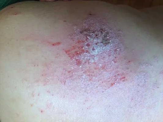 怎样治疗鹅口疮?