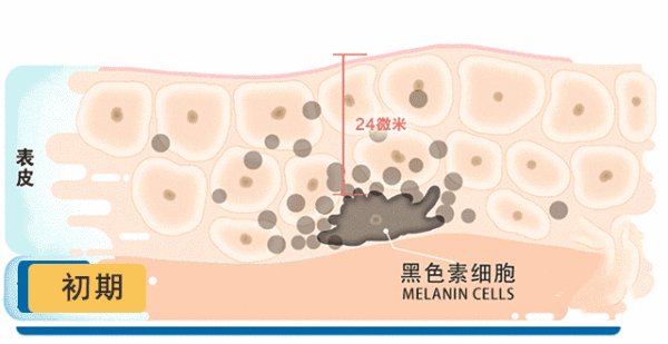 黄褐斑能彻底去除吗？