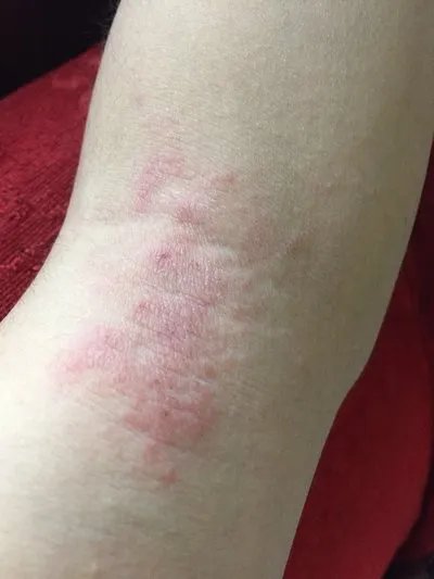 过敏性皮炎的症状